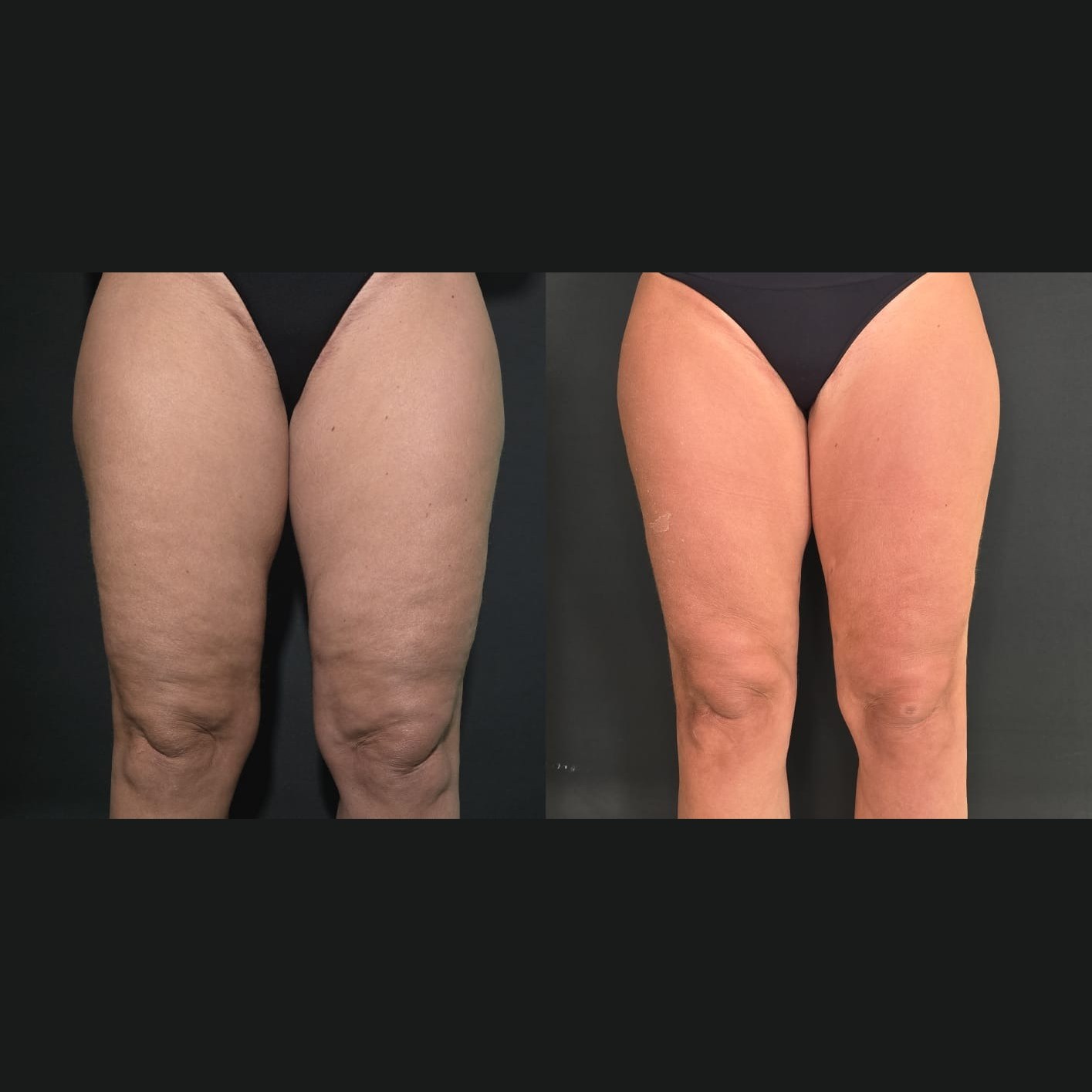 Antes x Depois — Estética Avançada · caso 2