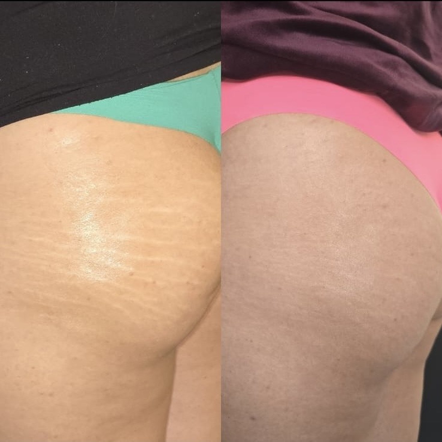 Antes x Depois — Estética Avançada · caso 5