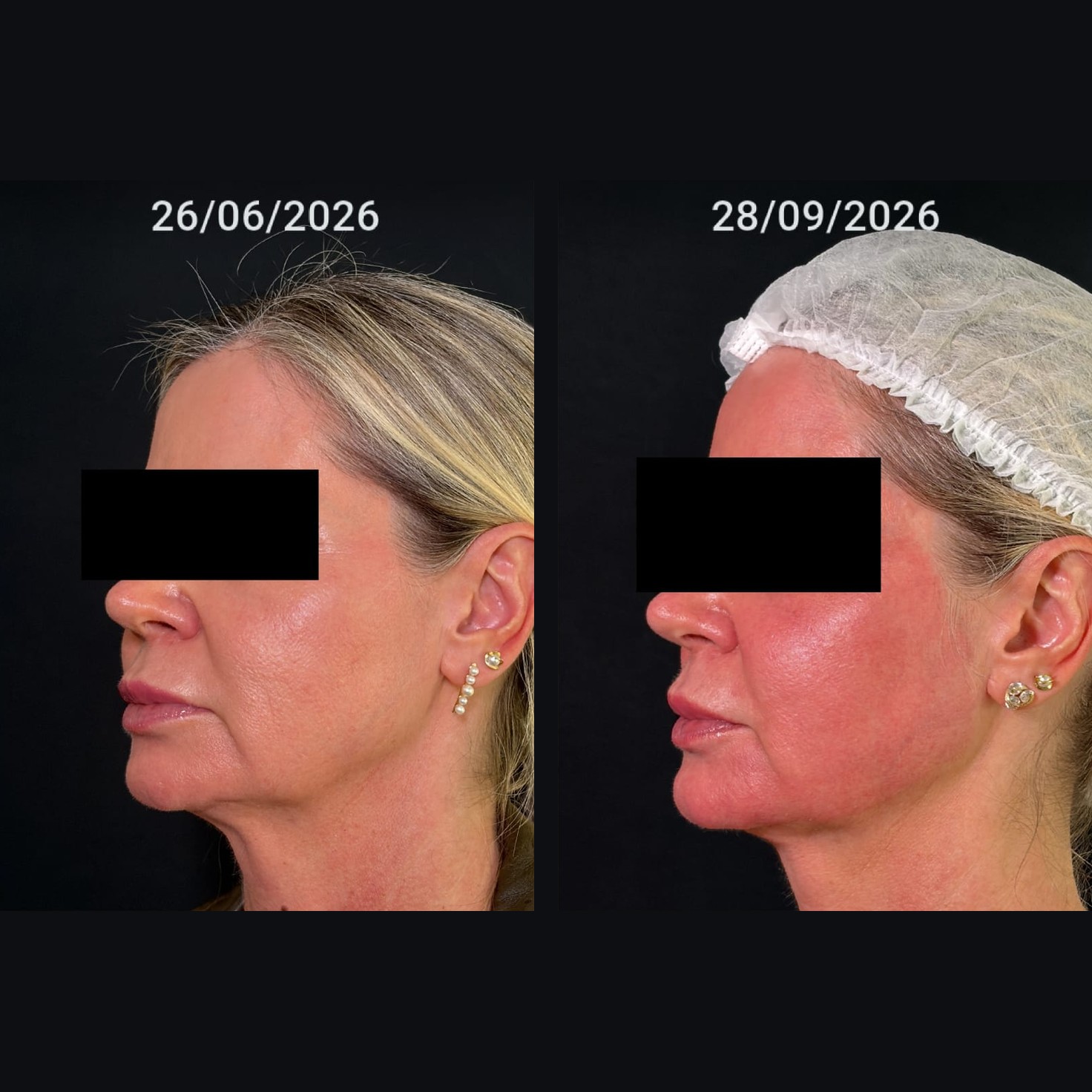 Antes x Depois — Contorno Facial · caso 1