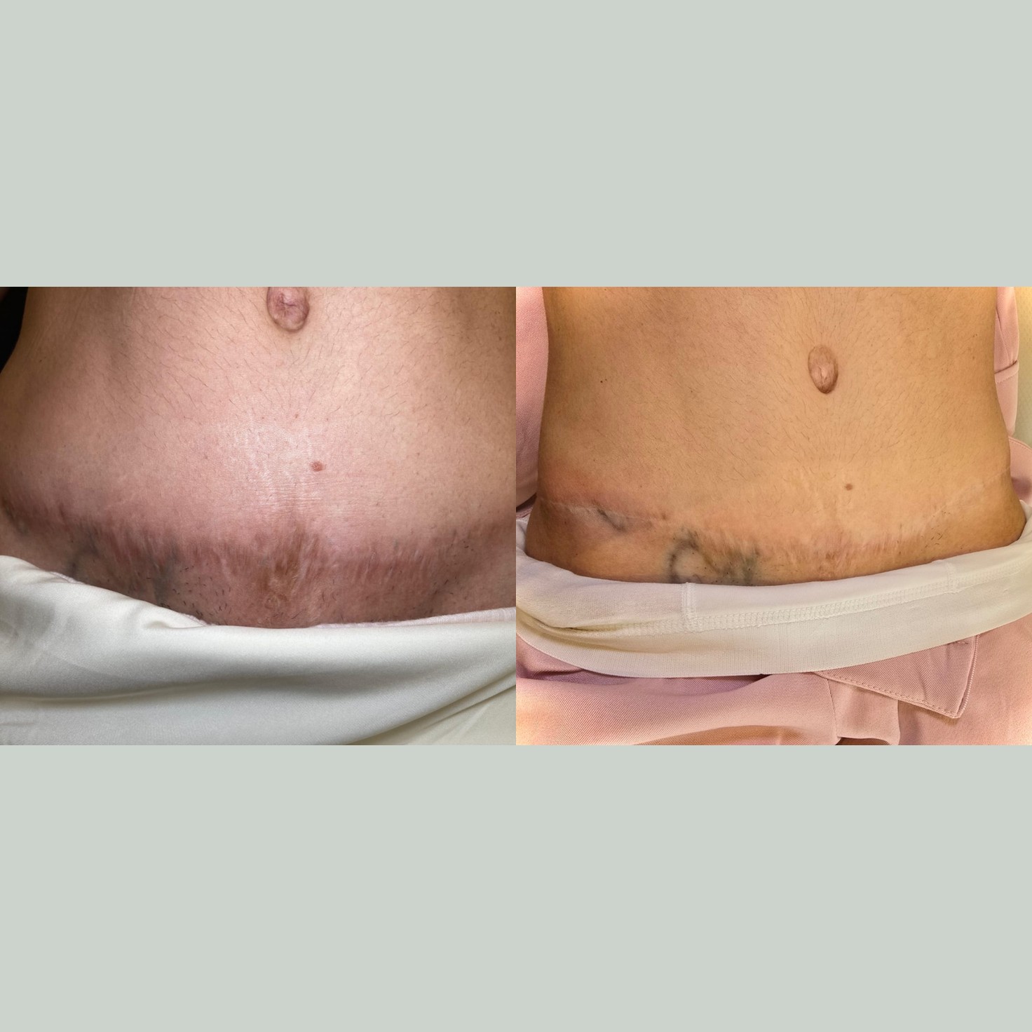 Antes x Depois — Cicatrizes · caso 1