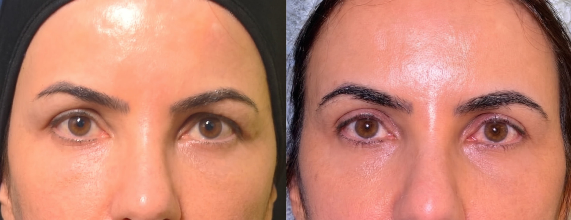 Comparativo de antes e depois da região das pálpebras enviado pela clínica