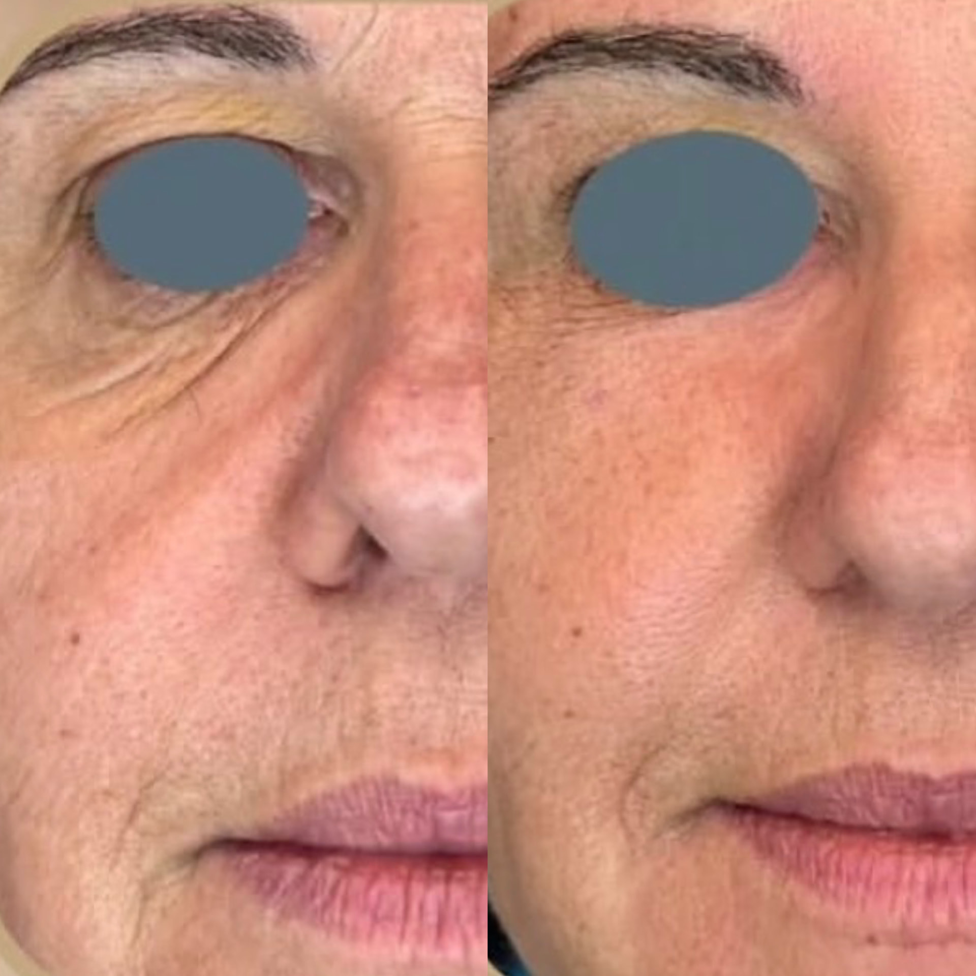 Antes x Depois — Youlaser Prime · caso 3