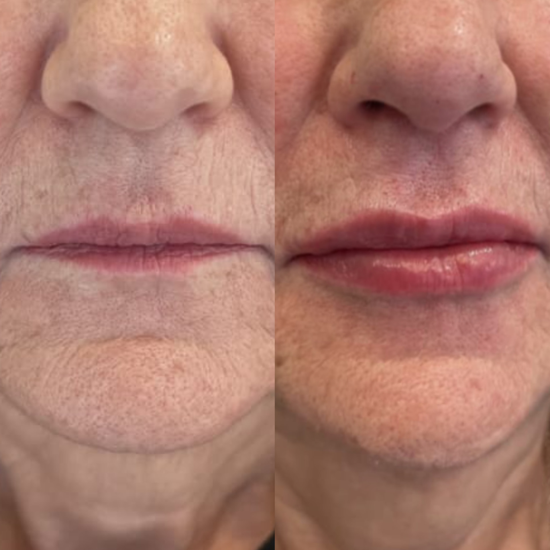 Antes x Depois — Preenchimento Labial · caso 2