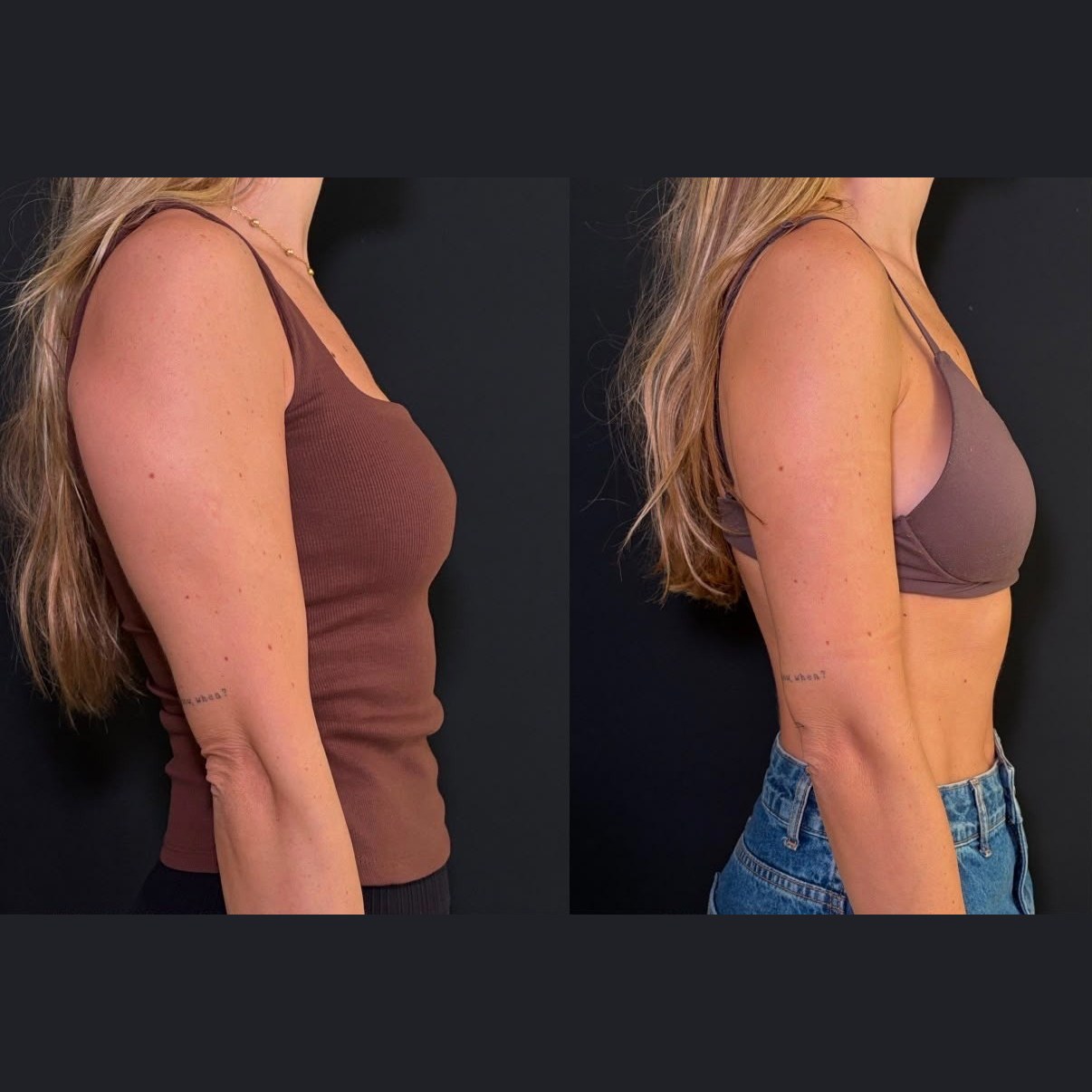 Antes x Depois — Estética Avançada · caso 3