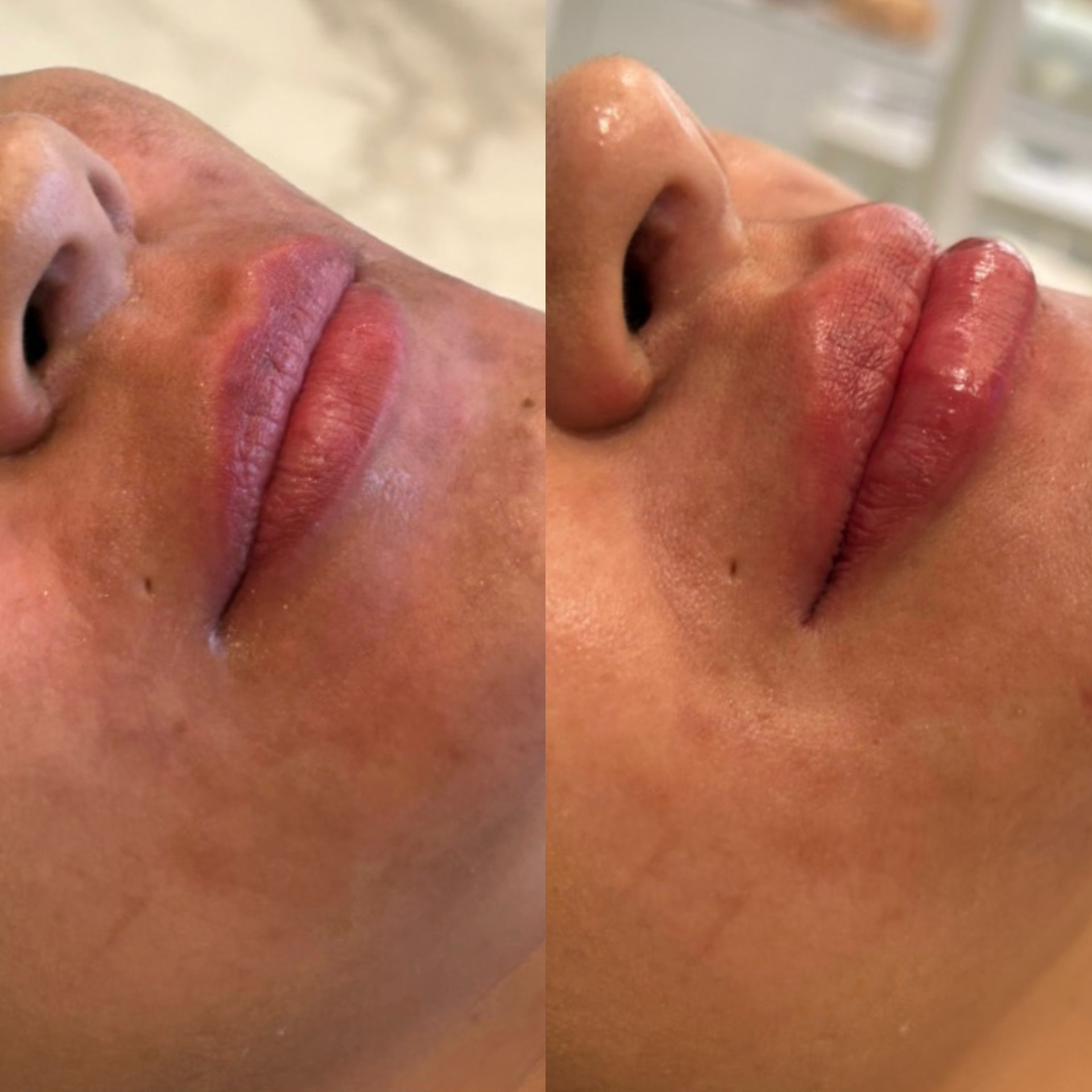 Antes x Depois — Preenchimento Labial · caso 3