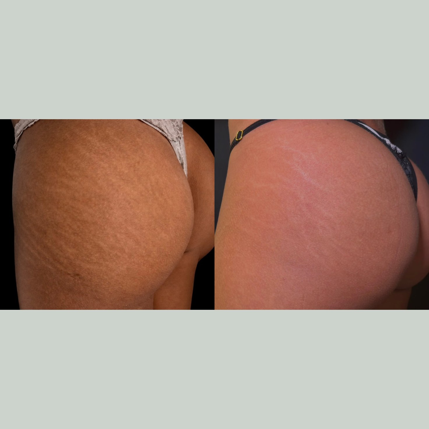 Antes x Depois — Estética Avançada · caso 4