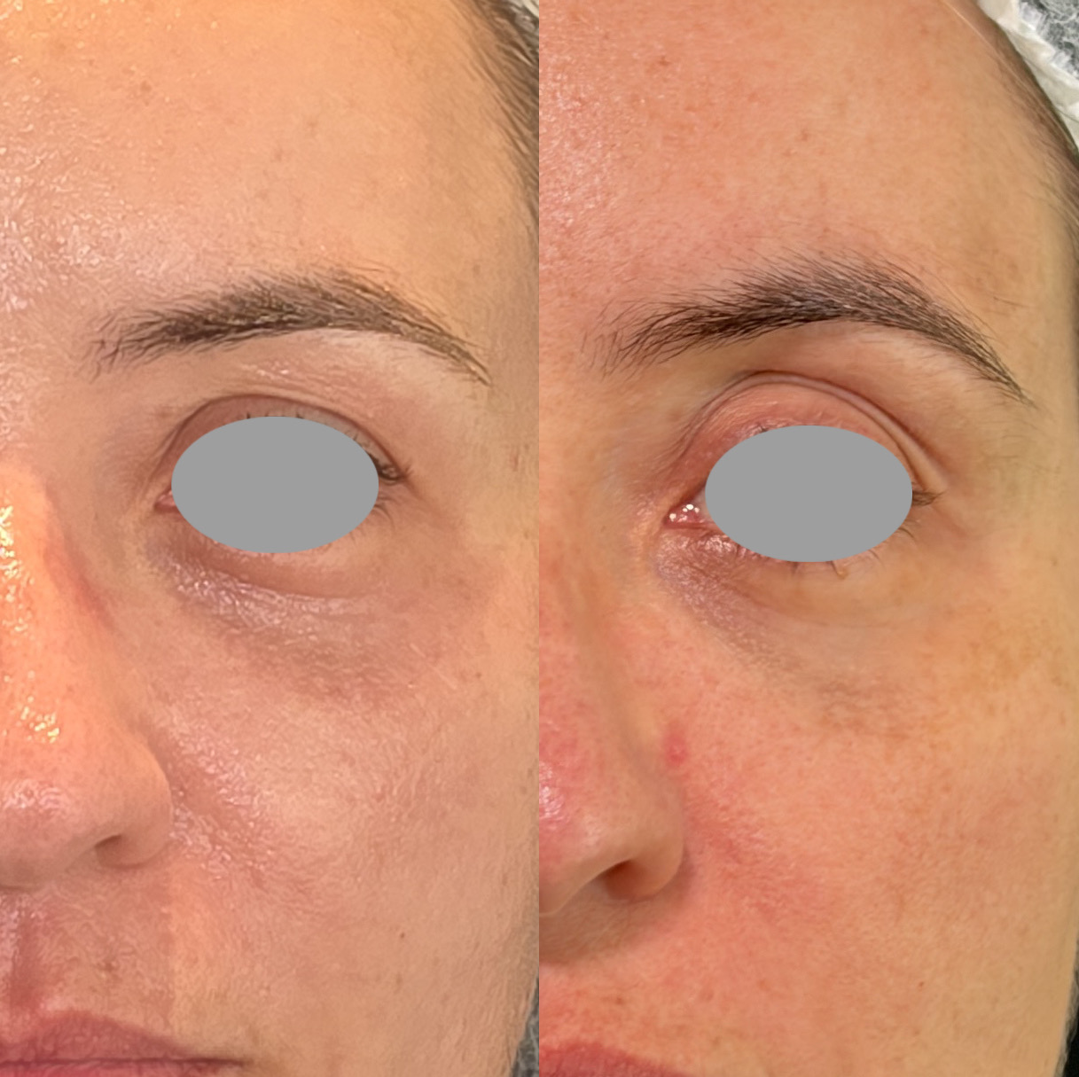 Antes x Depois — Youlaser Prime · caso 4