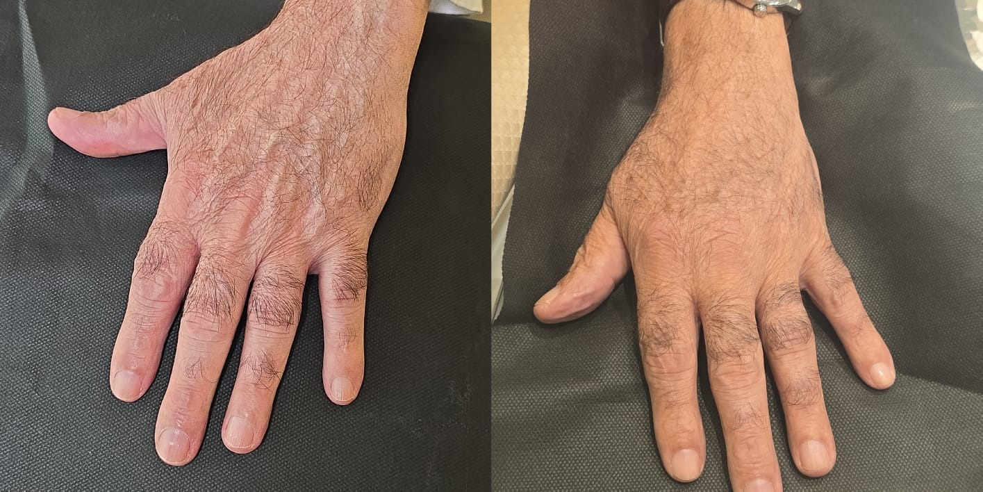 Antes x Depois — Preenchimento de Mãos · caso 1