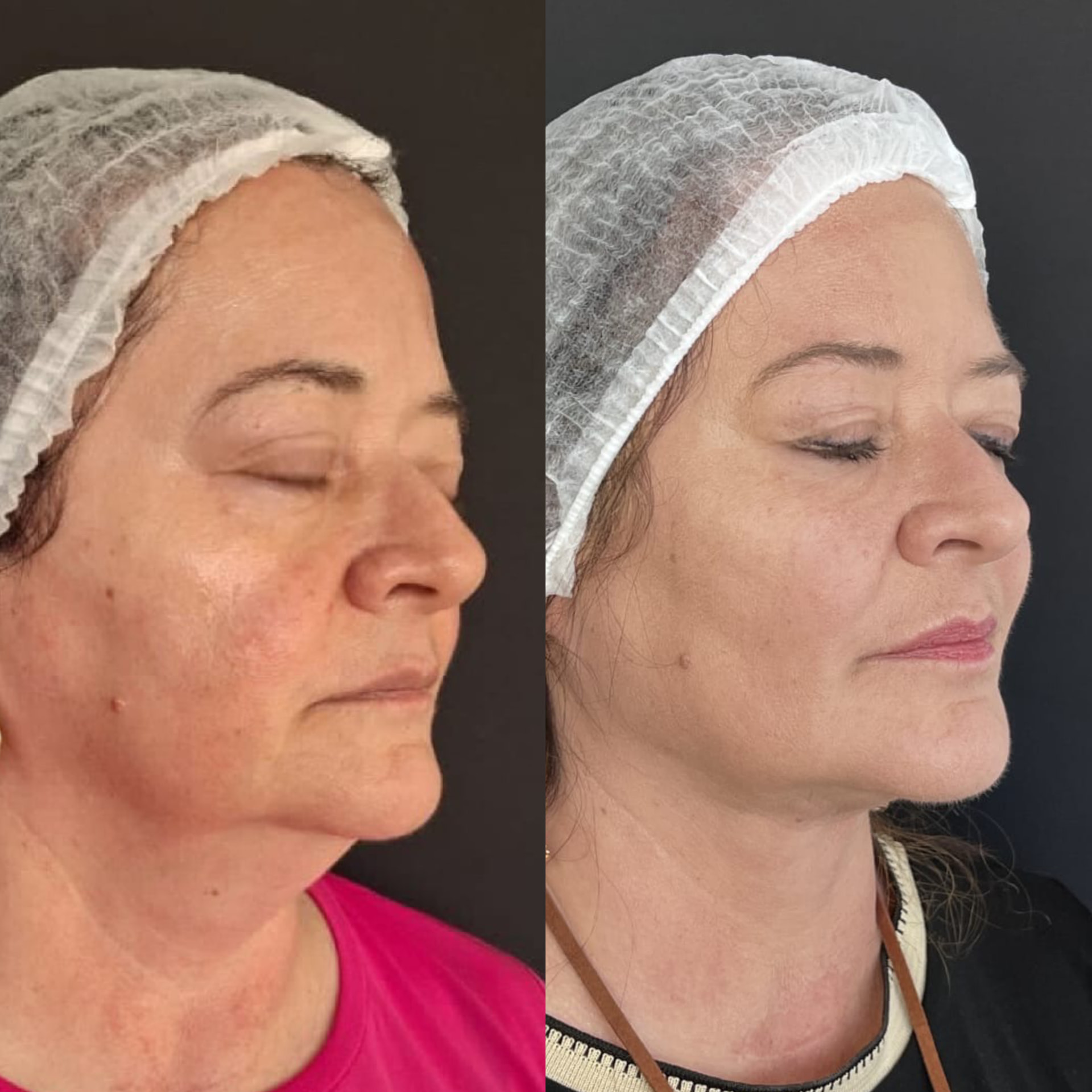 Antes x Depois — Dermatologia Clínica · caso 1