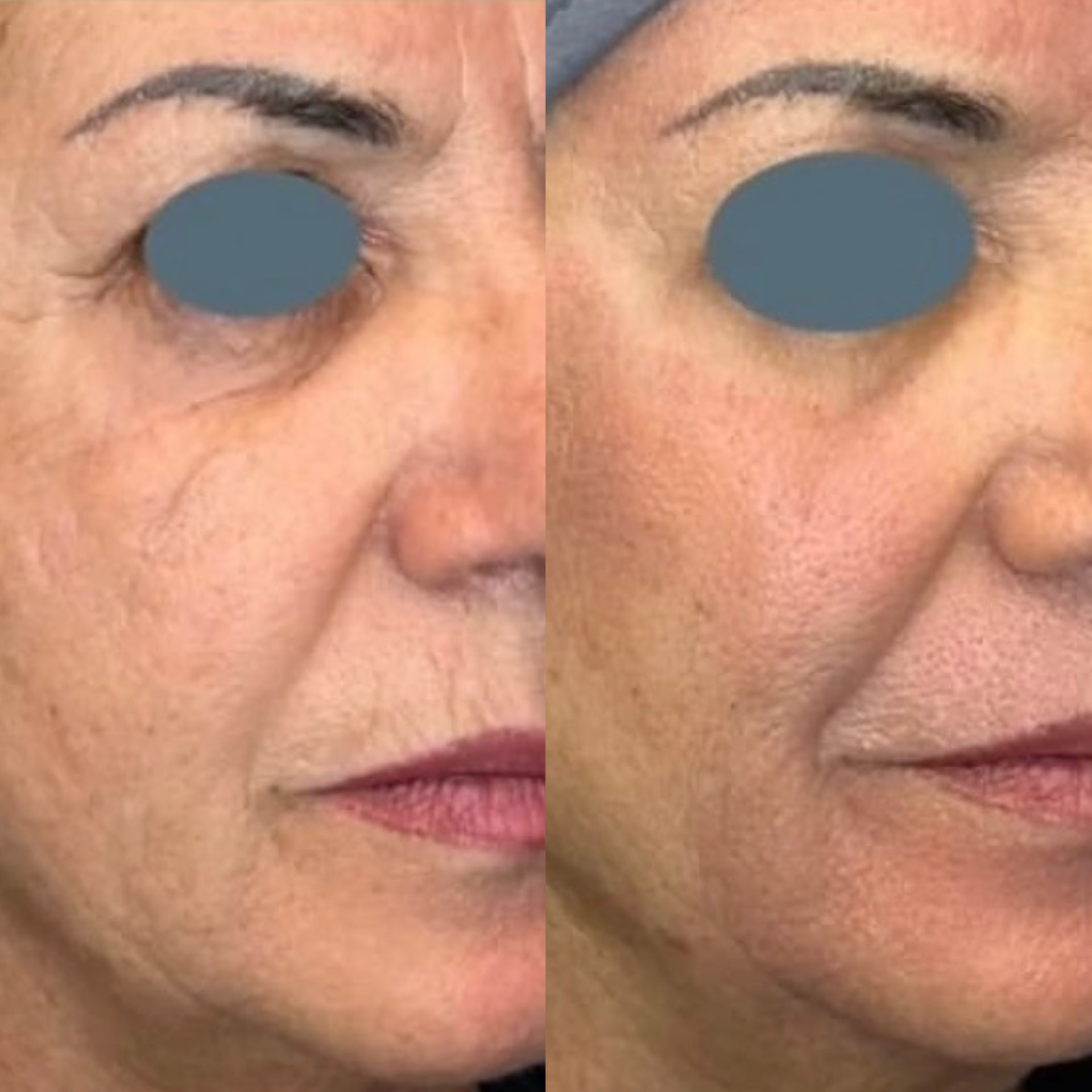Antes x Depois — Youlaser Prime · caso 2