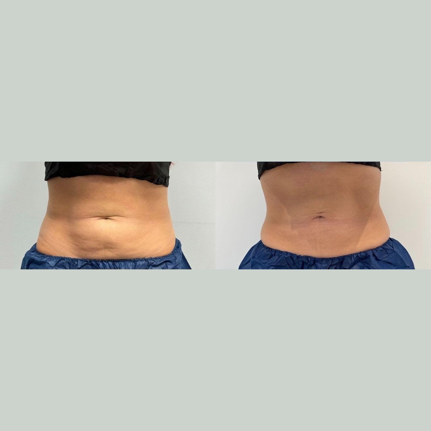 Antes x Depois — Estética Avançada · caso 1