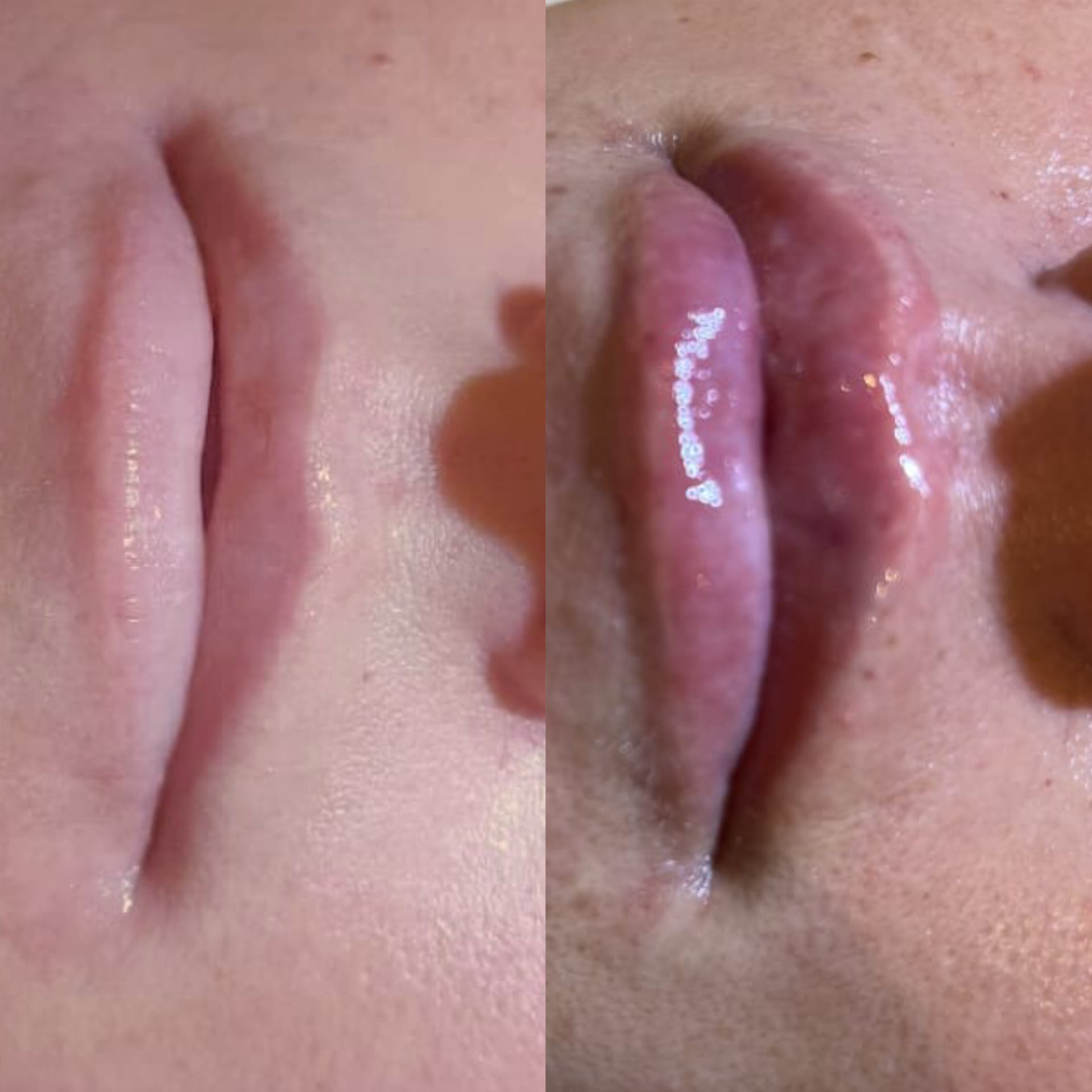 Antes x Depois — Preenchimento Labial · caso 1