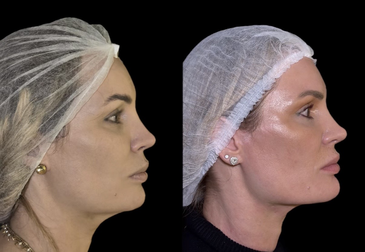 Antes x Depois — Youlaser Prime · caso 1